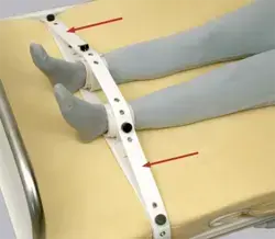 SEGUFIX<sup>&reg;</sup>-脚用ブレースストラップ